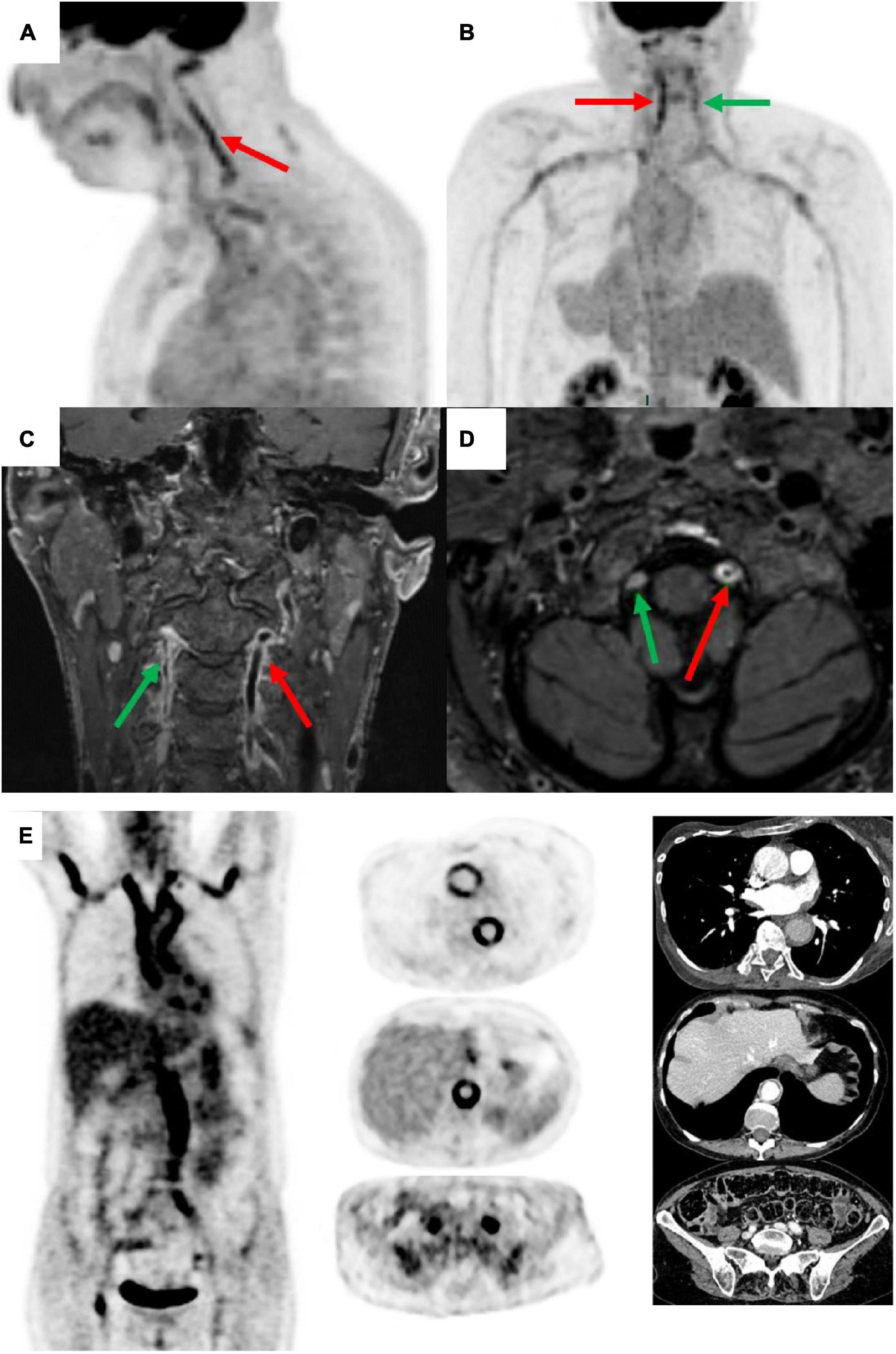 18-Fluorodeoxyglucose positron emission tomography/computed tomography for large vessel vasculitis in clinical practice